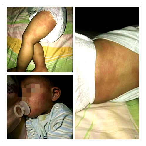 病案 | 發燒，蕁麻疹，幼兒急疹十來天 親子 第2張