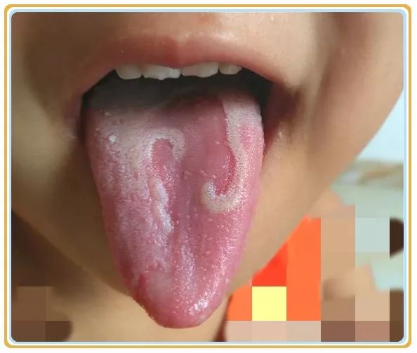 舌象 地图舌 花剥苔 羊爸爸 微信公众号文章阅读 Wemp