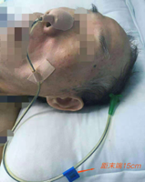 引流管怎么标识常见各类管道护理规范（评估、标识及固定）_https://www.jmylbn.com_新闻资讯_第2张