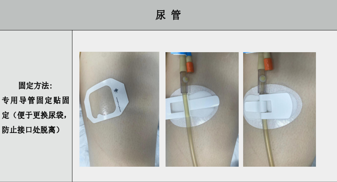 引流管怎么标识常见各类管道护理规范（评估、标识及固定）_https://www.jmylbn.com_新闻资讯_第7张