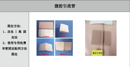 引流管怎么标识常见各类管道护理规范（评估、标识及固定）_https://www.jmylbn.com_新闻资讯_第5张