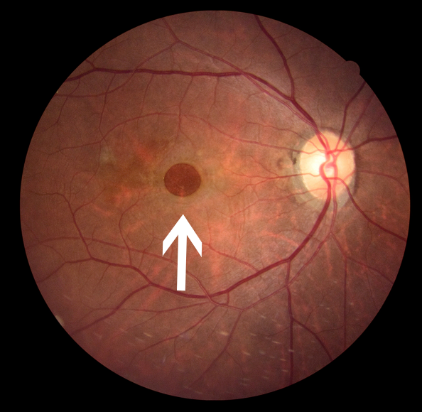 眼科ab超检查单怎么看常见眼底疾病检查结果的秒懂解读_https://www.jmylbn.com_新闻资讯_第8张