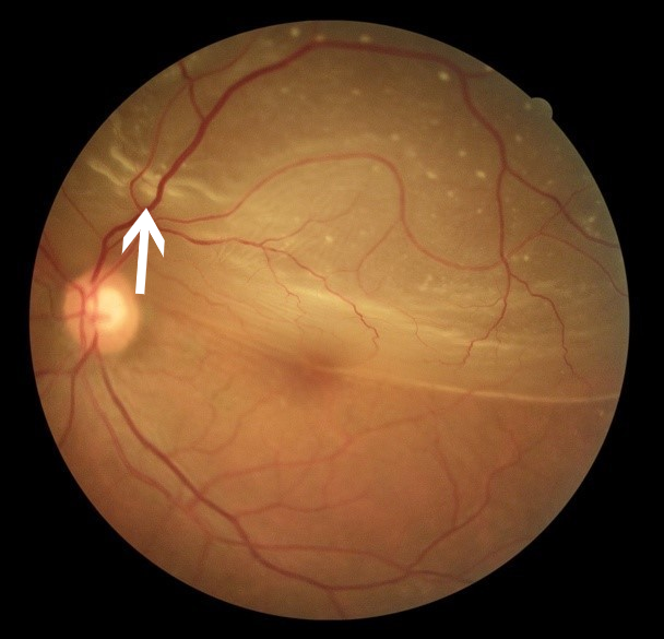 眼科ab超检查单怎么看常见眼底疾病检查结果的秒懂解读_https://www.jmylbn.com_新闻资讯_第26张
