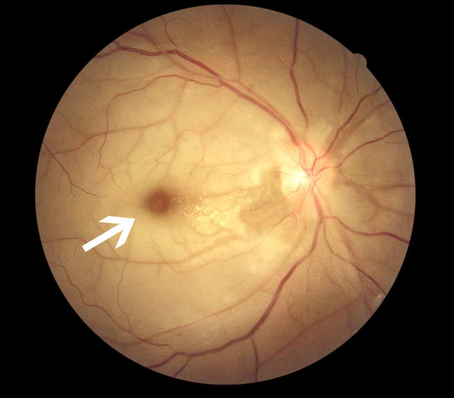 眼科ab超检查单怎么看常见眼底疾病检查结果的秒懂解读_https://www.jmylbn.com_新闻资讯_第13张