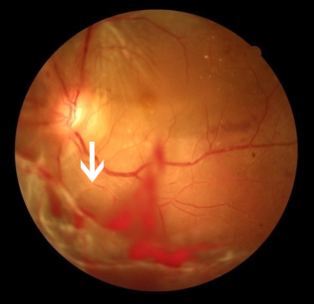 眼科ab超检查单怎么看常见眼底疾病检查结果的秒懂解读_https://www.jmylbn.com_新闻资讯_第19张