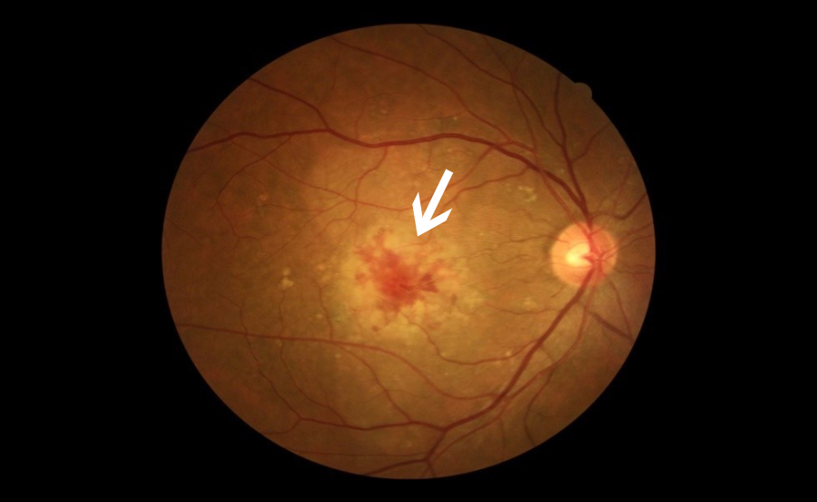 眼科ab超检查单怎么看常见眼底疾病检查结果的秒懂解读_https://www.jmylbn.com_新闻资讯_第23张