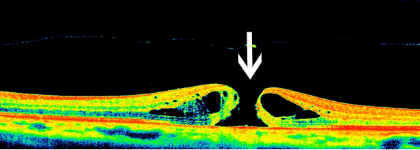 眼科ab超检查单怎么看常见眼底疾病检查结果的秒懂解读_https://www.jmylbn.com_新闻资讯_第9张
