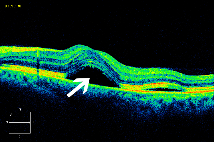 眼科ab超检查单怎么看常见眼底疾病检查结果的秒懂解读_https://www.jmylbn.com_新闻资讯_第6张