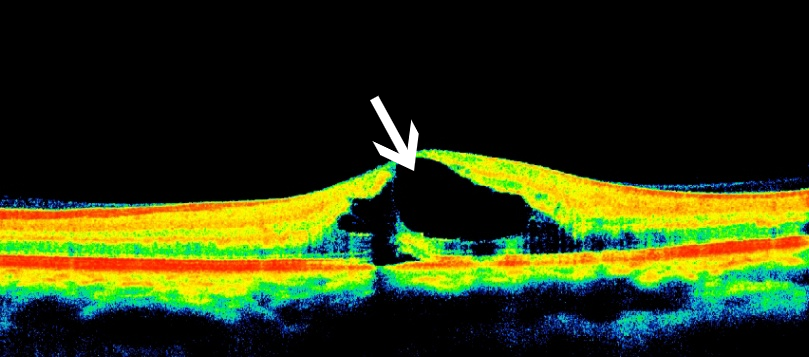 眼科ab超检查单怎么看常见眼底疾病检查结果的秒懂解读_https://www.jmylbn.com_新闻资讯_第12张