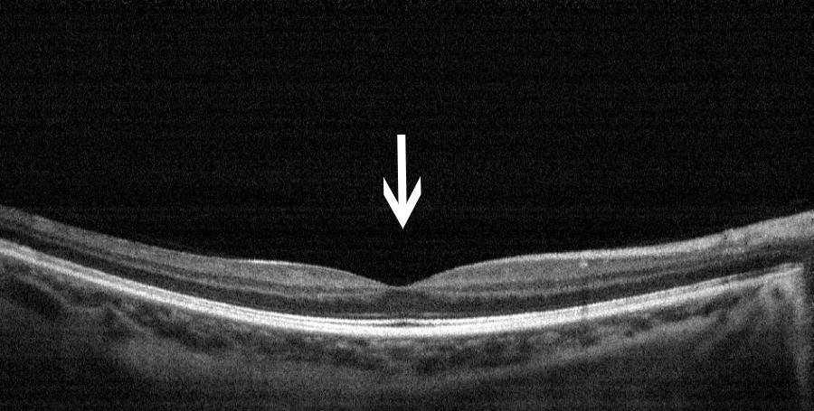 眼科ab超检查单怎么看常见眼底疾病检查结果的秒懂解读_https://www.jmylbn.com_新闻资讯_第4张
