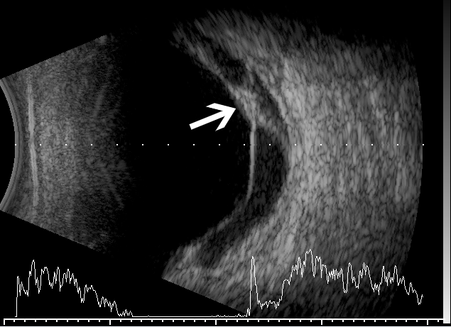 b超:玻璃体内积血,伴局部牵拉性视网膜脱离,呈"梯形板凳状"图片来源