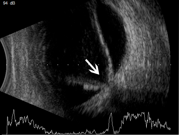 眼科ab超检查单怎么看常见眼底疾病检查结果的秒懂解读_https://www.jmylbn.com_新闻资讯_第27张