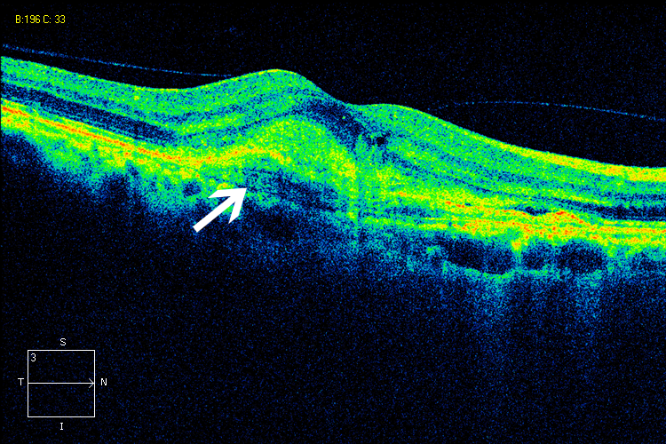 眼科ab超检查单怎么看常见眼底疾病检查结果的秒懂解读_https://www.jmylbn.com_新闻资讯_第25张