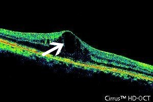 眼科ab超检查单怎么看常见眼底疾病检查结果的秒懂解读_https://www.jmylbn.com_新闻资讯_第16张