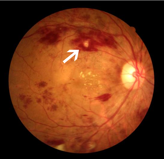 眼底彩照:眼底黄斑区黄白色渗出,视网膜诸多出血图片来源:天津市眼科