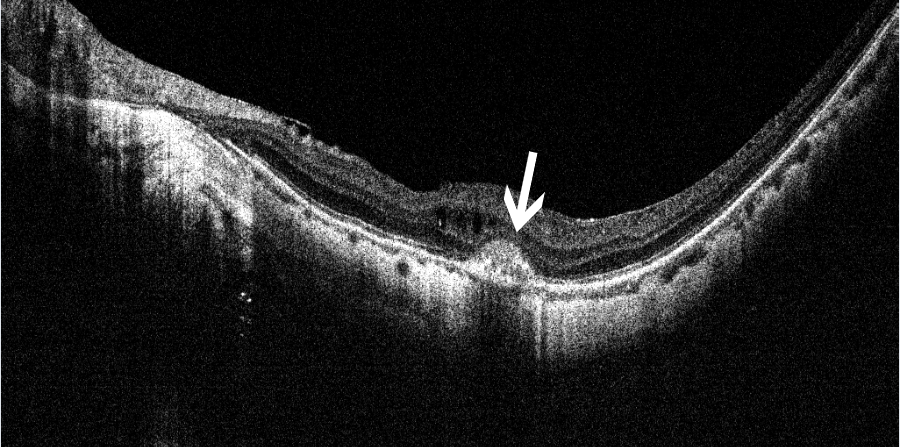 眼科ab超检查单怎么看常见眼底疾病检查结果的秒懂解读_https://www.jmylbn.com_新闻资讯_第30张