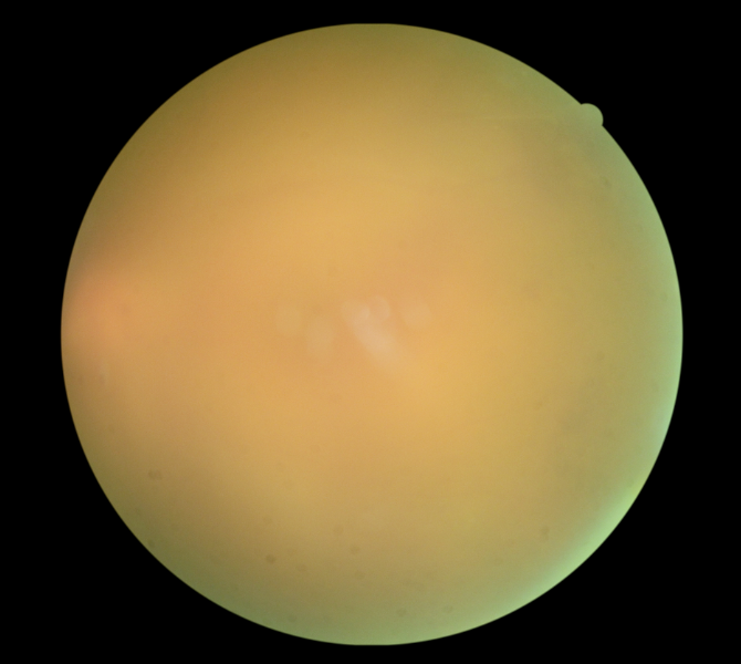 眼科ab超检查单怎么看常见眼底疾病检查结果的秒懂解读_https://www.jmylbn.com_新闻资讯_第17张