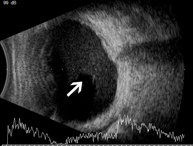 眼科ab超检查单怎么看常见眼底疾病检查结果的秒懂解读_https://www.jmylbn.com_新闻资讯_第18张