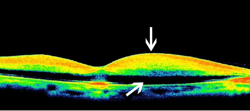 眼科ab超检查单怎么看常见眼底疾病检查结果的秒懂解读_https://www.jmylbn.com_新闻资讯_第14张