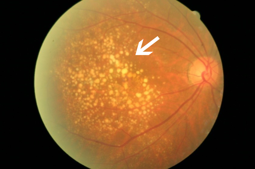 天津市眼科医院年龄相关性黄斑变性(湿性)眼底彩照:黄斑区出血,出血