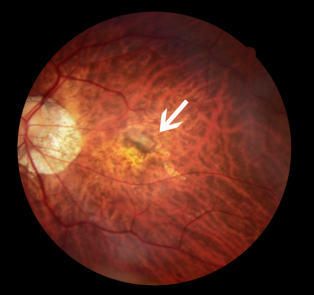 眼底彩照:豹纹状眼底,黄斑区出血,出血周边呈黄白色图片来源:天津市