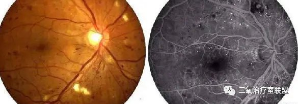 什么是臭氧大自血疗法【专家共识】三氧大自血疗法--血液好身体就好！_https://www.jmylbn.com_新闻资讯_第8张