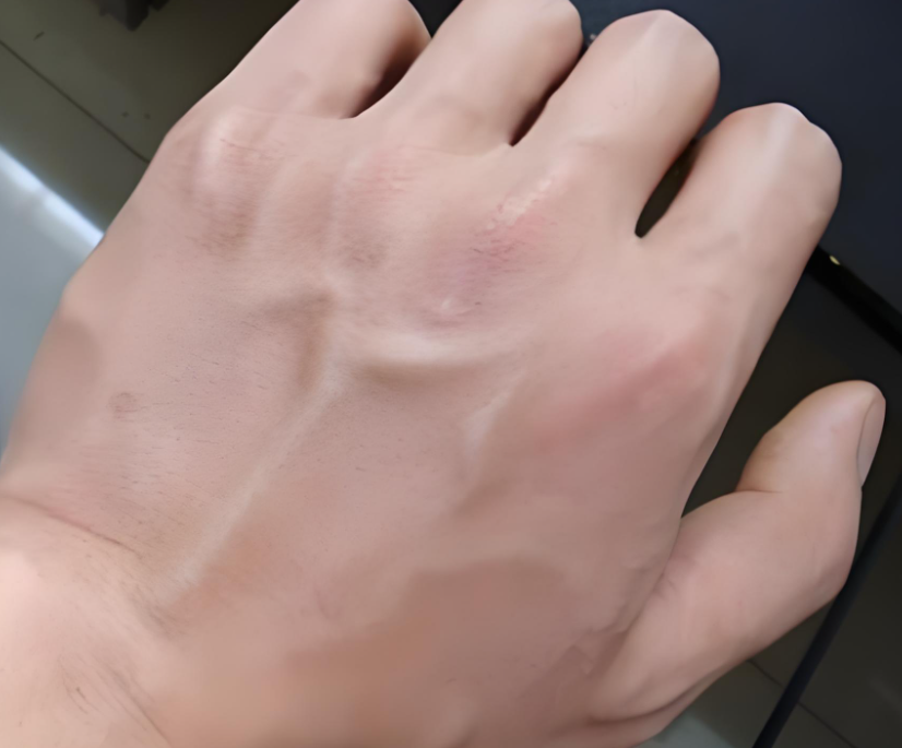 为什么输血不能用小针护士，留置针又不滴了！其实只需做一个小改变...._https://www.jmylbn.com_新闻资讯_第7张