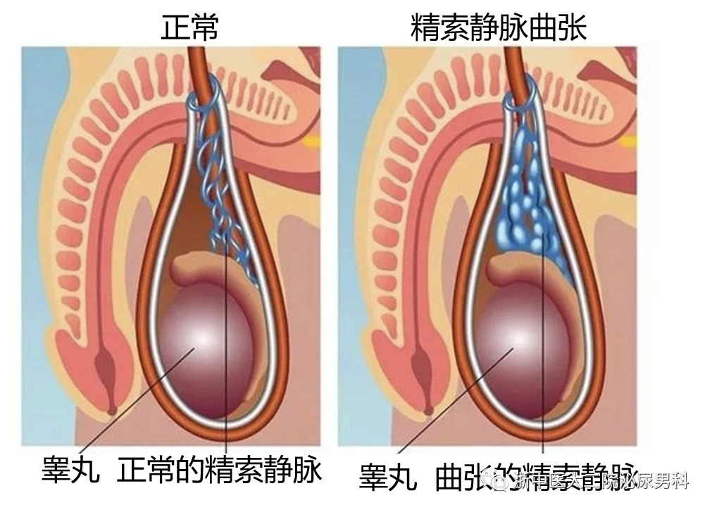 由于精索静脉曲张能够对睾丸产生明显的不良影响,可以造成男性的精液