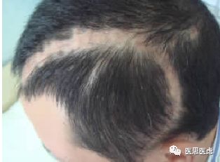 手术头皮夹怎么放神外有趣的小物件---头皮夹_https://www.jmylbn.com_新闻资讯_第9张