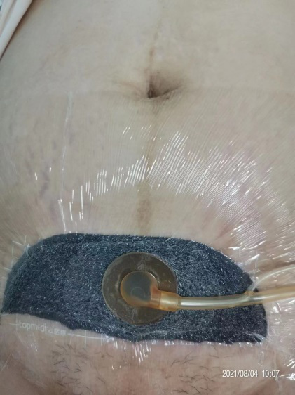 伤口负压治疗怎么收费剖腹产术后脂肪液化伤口快速愈合之利器 ——负压治疗_https://www.jmylbn.com_新闻资讯_第7张