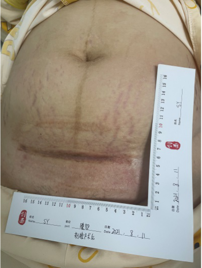 伤口负压治疗怎么收费剖腹产术后脂肪液化伤口快速愈合之利器 ——负压治疗_https://www.jmylbn.com_新闻资讯_第8张