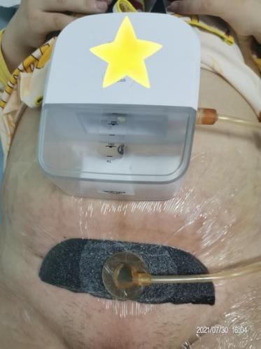 伤口负压治疗怎么收费剖腹产术后脂肪液化伤口快速愈合之利器 ——负压治疗_https://www.jmylbn.com_新闻资讯_第4张