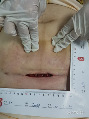 伤口负压治疗怎么收费剖腹产术后脂肪液化伤口快速愈合之利器 ——负压治疗_https://www.jmylbn.com_新闻资讯_第3张