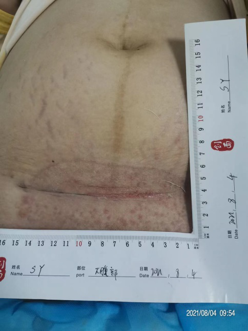 伤口负压治疗怎么收费剖腹产术后脂肪液化伤口快速愈合之利器 ——负压治疗_https://www.jmylbn.com_新闻资讯_第5张