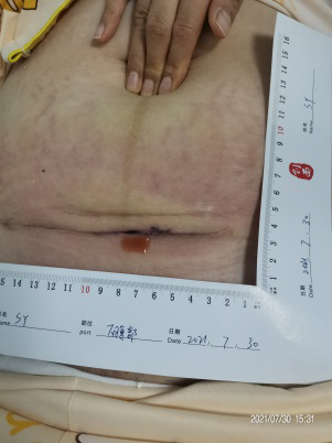 伤口负压治疗怎么收费剖腹产术后脂肪液化伤口快速愈合之利器 ——负压治疗_https://www.jmylbn.com_新闻资讯_第2张