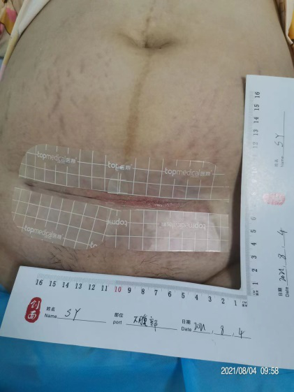 伤口负压治疗怎么收费剖腹产术后脂肪液化伤口快速愈合之利器 ——负压治疗_https://www.jmylbn.com_新闻资讯_第6张