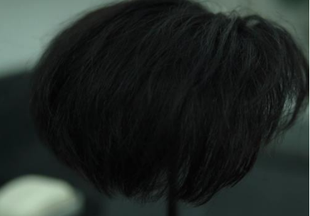 张东升的“秃顶”是用脑过度造成的，还是属于脂溢性脱发？