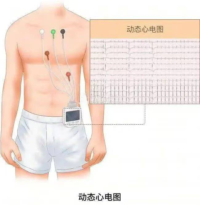 holter电极怎么贴【健康资讯】守护心脏健康的秘密武器——Holter_https://www.jmylbn.com_新闻资讯_第2张