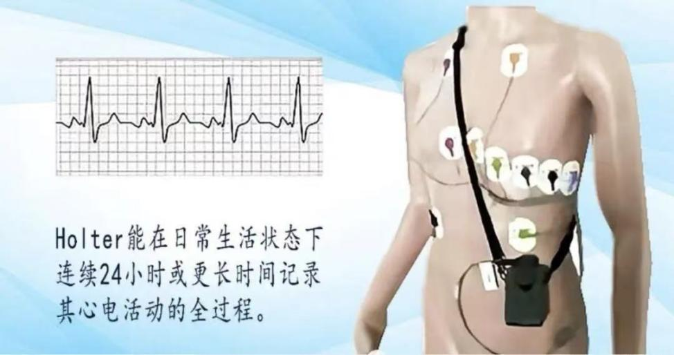 holter电极怎么贴【健康资讯】守护心脏健康的秘密武器——Holter_https://www.jmylbn.com_新闻资讯_第3张