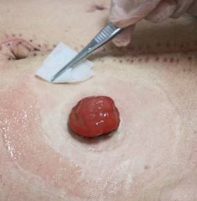 膀胱造口的更换方法 - 好大夫在线