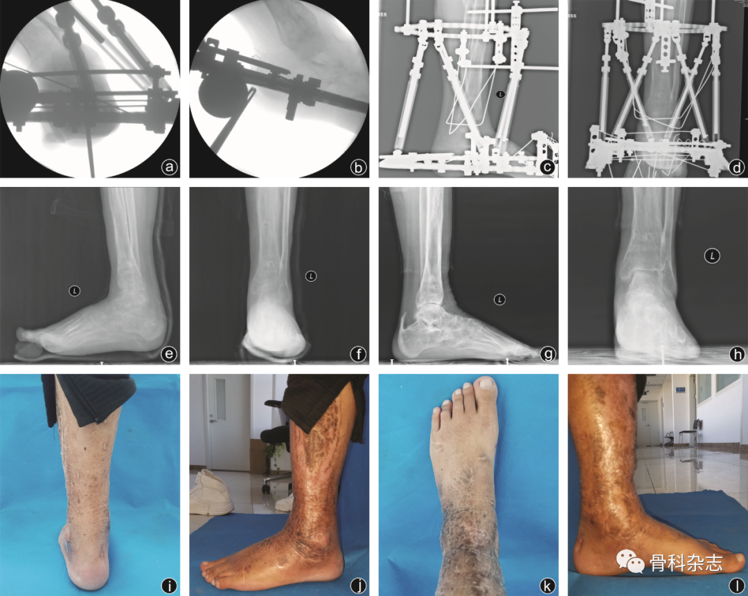 什么是外固定架【外固定肢体重建】泰勒空间外架技术结合足部“U”形截骨治疗创伤后马蹄内翻足畸形_https://www.jmylbn.com_新闻资讯_第2张
