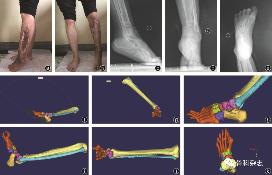 什么是外固定架【外固定肢体重建】泰勒空间外架技术结合足部“U”形截骨治疗创伤后马蹄内翻足畸形_https://www.jmylbn.com_新闻资讯_第1张