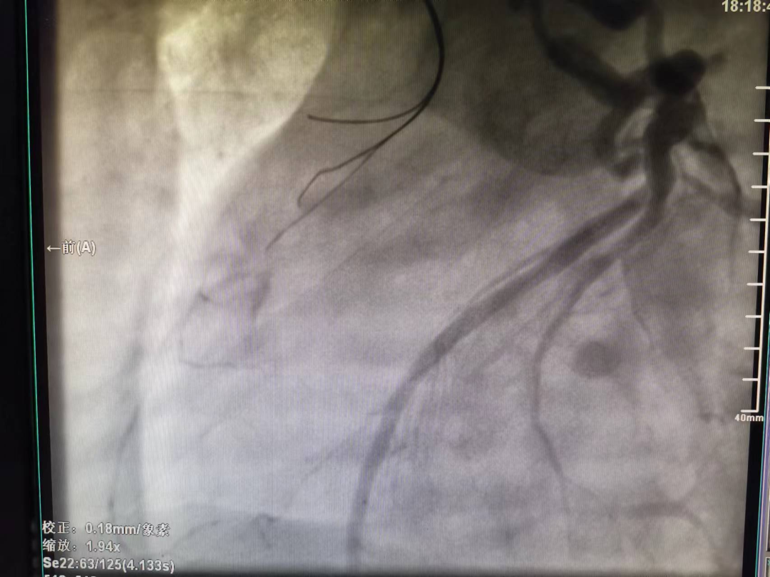 造影导丝是什么再克技术堡垒  巧破闭塞病变——心血管内科应用平行导丝技术救治冠脉慢性完全闭塞患者！_https://www.jmylbn.com_新闻资讯_第7张