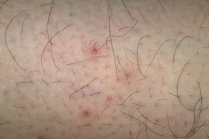 外阴上的毛囊炎怎么治，如何科学的去治疗毛囊炎