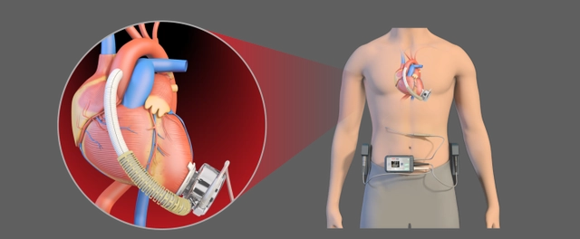 心肌三合一是什么“三合一”手术，植入中国心！_https://www.jmylbn.com_新闻资讯_第2张