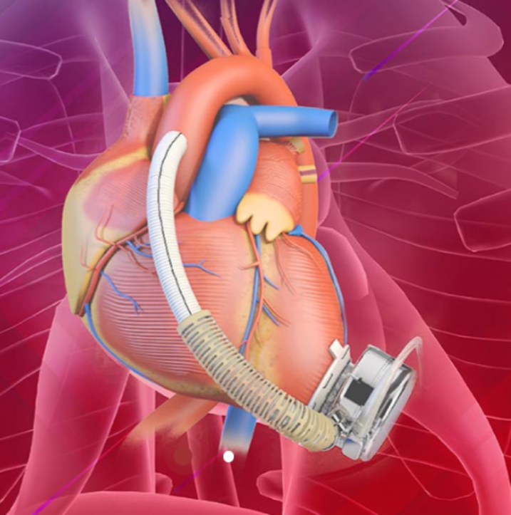 心肌三合一是什么“三合一”手术，植入中国心！_https://www.jmylbn.com_新闻资讯_第3张