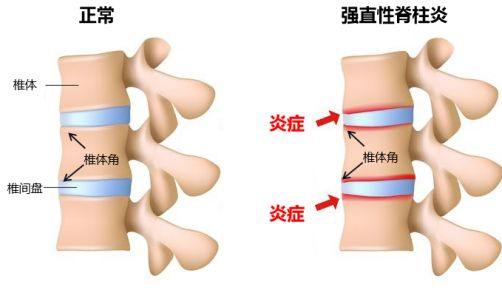 脊柱炎是什么症状图片