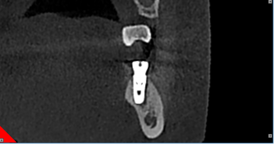什么牌子口腔ct最好【口腔· 科普】CBCT（口腔CT）_https://www.jmylbn.com_新闻资讯_第6张