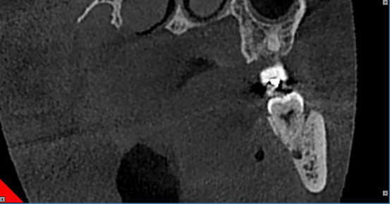 什么牌子口腔ct最好【口腔· 科普】CBCT（口腔CT）_https://www.jmylbn.com_新闻资讯_第24张