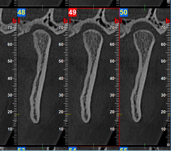 什么牌子口腔ct最好【口腔· 科普】CBCT（口腔CT）_https://www.jmylbn.com_新闻资讯_第12张